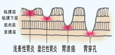 潰瘍導致胃出血